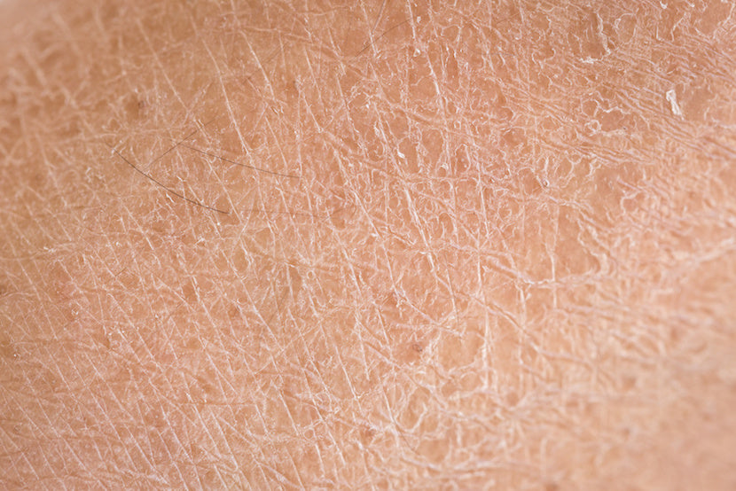 A closeup photo of dry skin