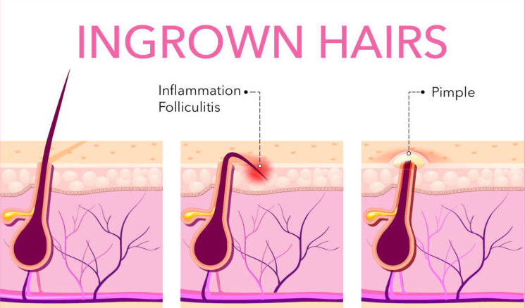 Diagram of ingrown hair formation before treatment with Glycolic Acid Body Scrub by SLMD Skincare