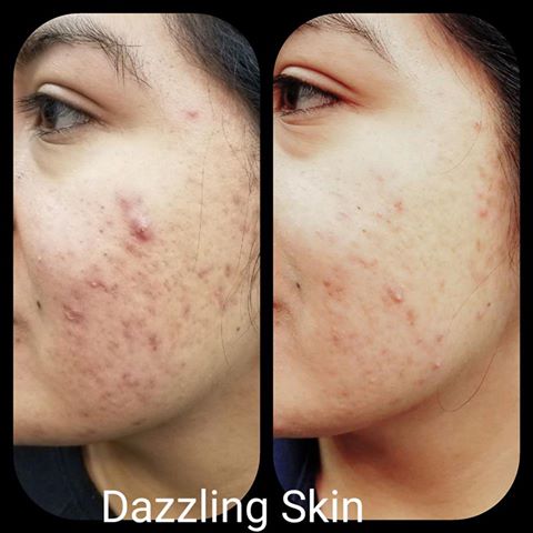 Dazzling Skin microcurrent facial treatment reduced redness and soothing skin
