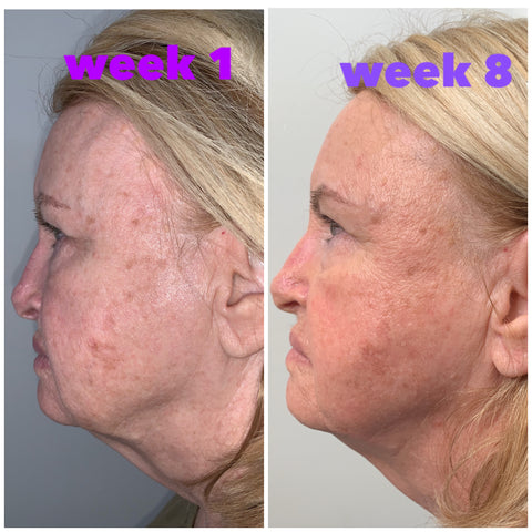myolift microcurrent progress from skincare by shannon in florida