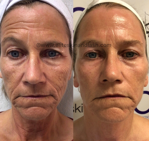 Elite Skin and Lash before and after photos with microcurrent myolift machine