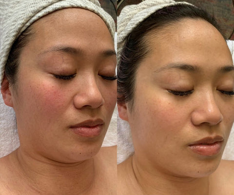 before and after myolift microcurrent facial treatment 