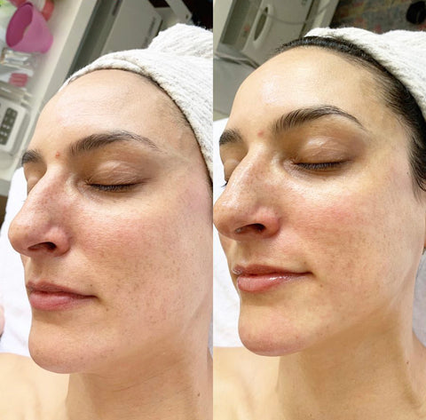 before and after 7e myolift microcurrent facial lifting treatment