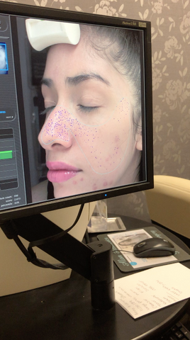 Skin Scanner Enlarged Pores