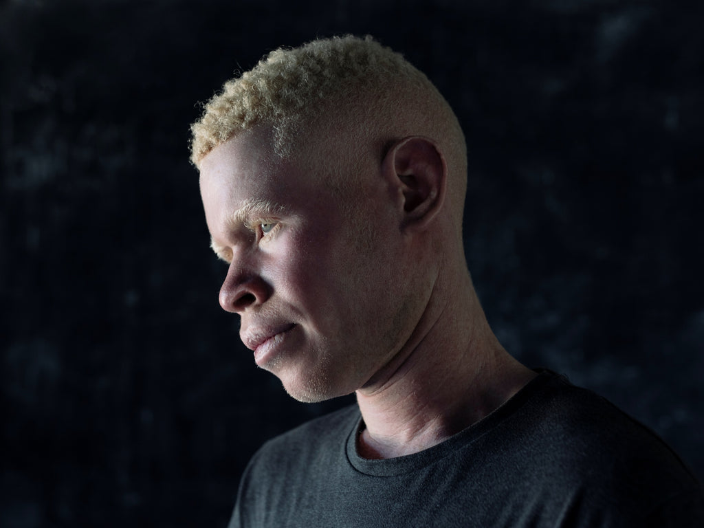 Persecution of Albinos for witchcraft in DRC & Uganda. © Paddy Dowling/EAA