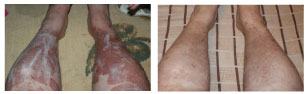 Best Psoriasis Treatment