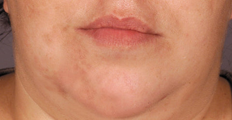 Dermasolve CMost After