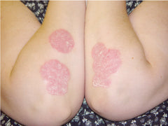 psoriasis on elbows