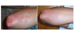 Psoriasis Treatment