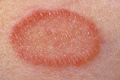 Psoriasis and Pityriasis