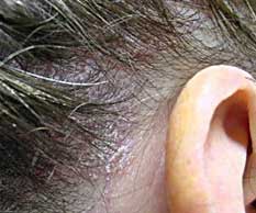 Scalp Psoriasis