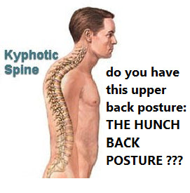 Hunchback Posture
