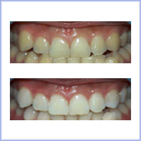 Excellent teeth whitening with POPWHITE purple toothpaste and oral care products