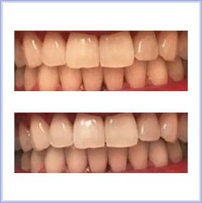 Excellent teeth whitening with POPWHITE purple toothpaste and oral care products