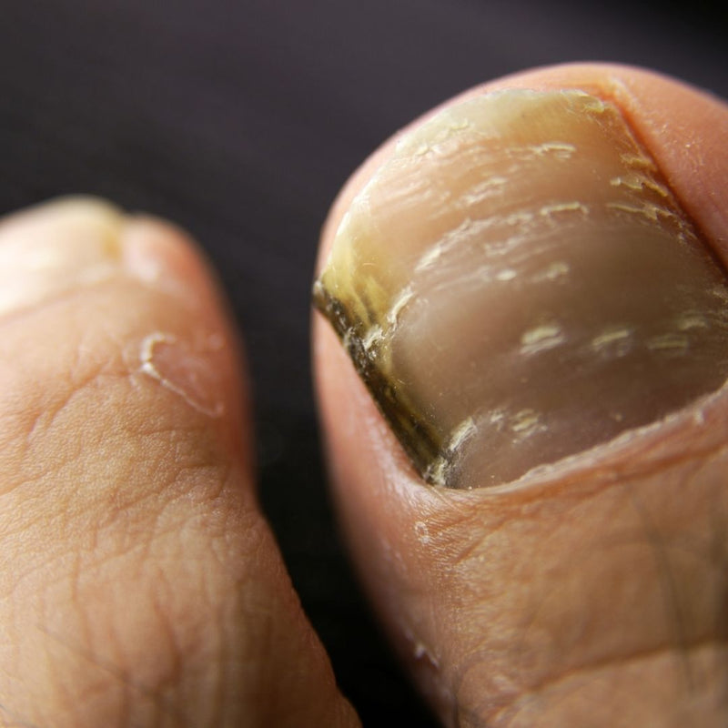 What is Black Toenail Fungus? | Forces of Nature Medicine