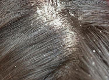 Dandruff: What Is It, and How To Get Rid Of It Today! – Garner's Garden