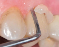 Cementos dentales - CCS Dental