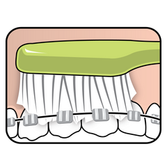 TePe Supreme para ortodoncia