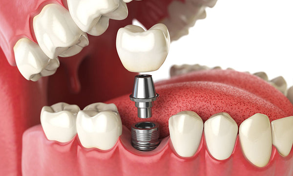 Esquema de implante dental