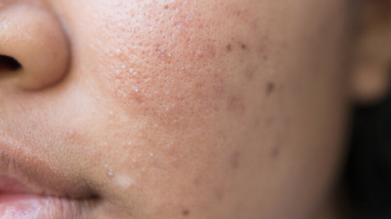 does collagen help acne