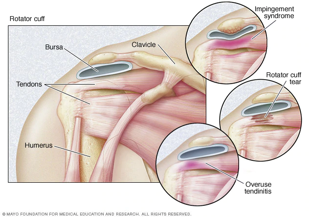 calcific tendonitis shoulder exercises: illustration of tendons