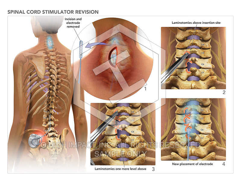 spinal stimulator dorsal column myelopathy