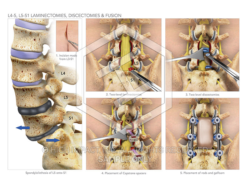 Image 08922 L4 5 L5 S1 Laminectomies Discectomies And Fusion Illustra 