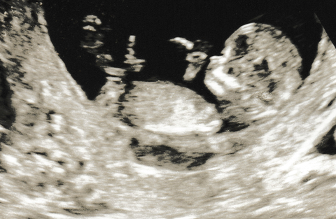 Ultrasound at 12 Weeks Gestation