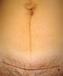 "cicatrice del taglio cesareo e linea nigra