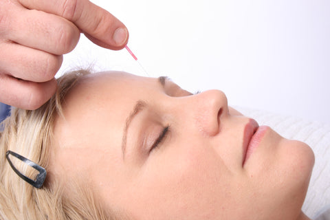 Cosmetic Acupuncture