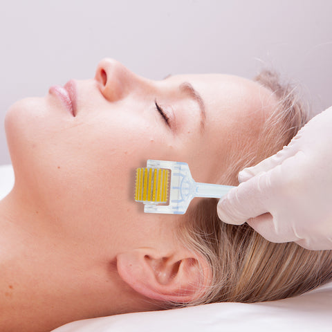 is microneedling for acne scars permanent