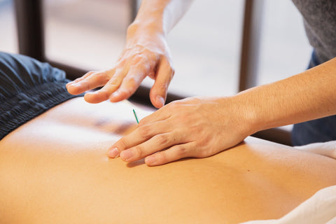 difference between acupuncture and dry needling