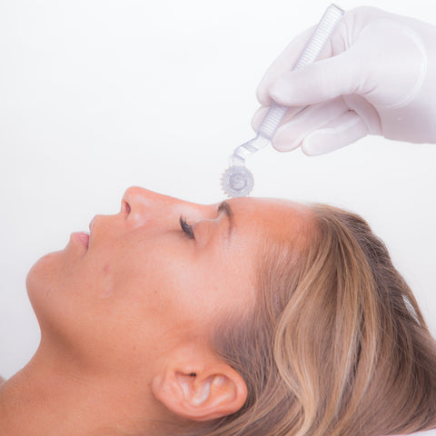 hvor mange microneedling sessioner for acne ar