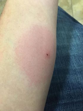 brown recluse spider bite