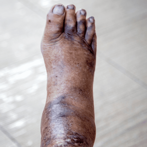 foot with Protein C Deficiency