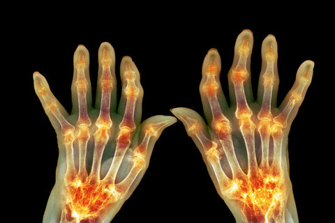 Rheumatoid arthritis x-ray