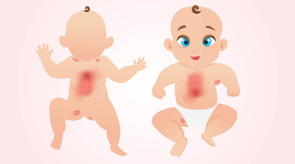 ppearance of tiny, moist red bumps on the face and in the skin folds of the neck, arms, legs, upper chest and diaper area