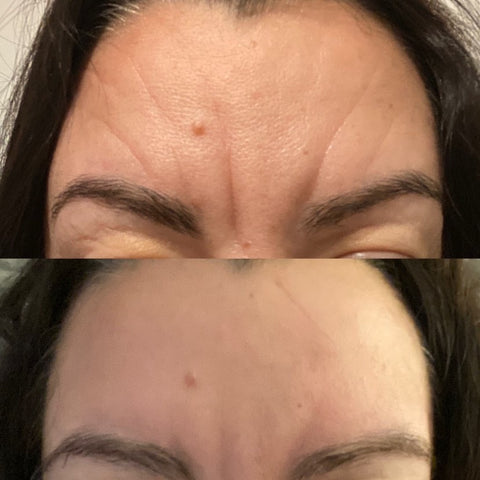 Before & after Frownies Wrinkle patch see a woman's forehead  with very deep smoothed the wrinkles between the eyes & wrinkles on the forehead.