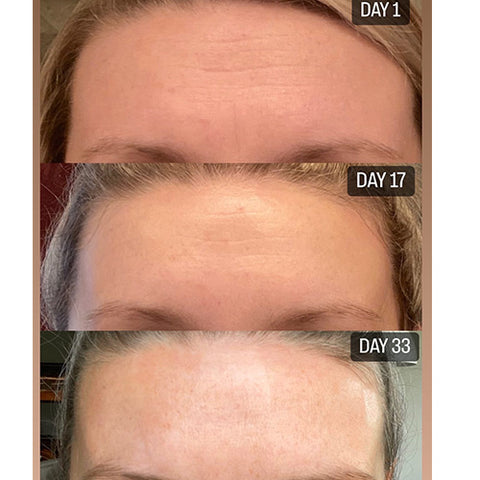 Forehead with wrinkles day 1, 17, and 33 days after using Frownies Facial Patches