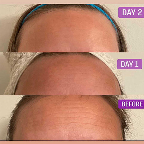 Before and after 3 days using Frownies Facial Patches for forehead wrinkles