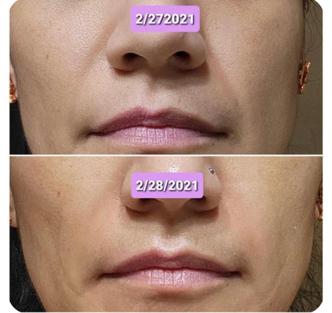 Smile lines, marionette lines around the mouth before and after using Frownies Facial Patches