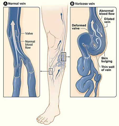 Why Do My Veins Bulge? – LegSmart Compression Socks