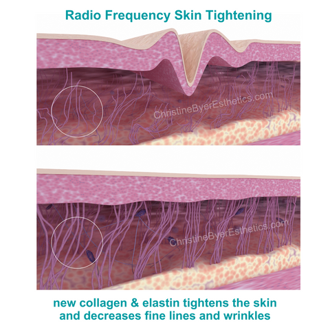 Radio Frequency Skin Tightening