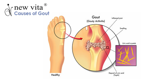 causes of gout