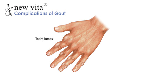 complications of gout