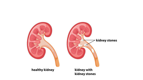 kidney stones of gout
