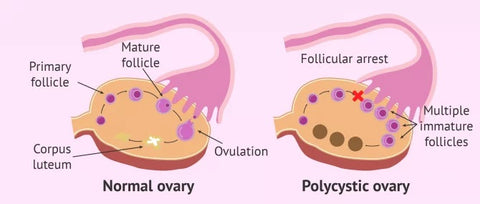 Ovulation disorders