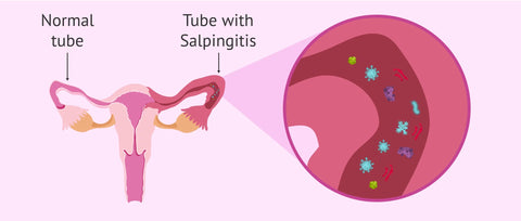 Fallopian tube damage or blockage