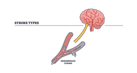 hemorragic stroke