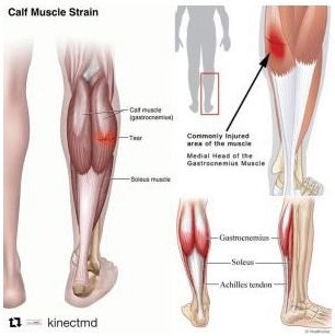 Calf Cramps Can Cause Calf Strains With Long-lasting Impact